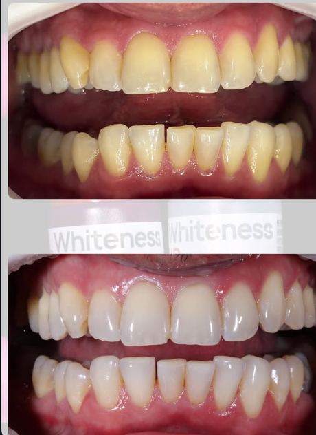 Antes e depois de clareamento dental
