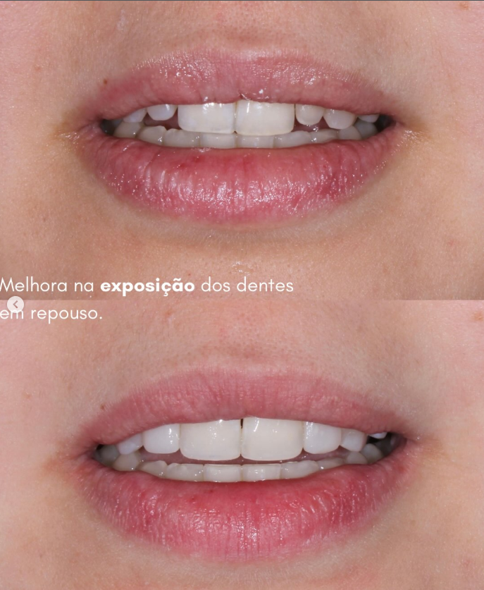 Antes e depois com melhora da exposição dos dentes