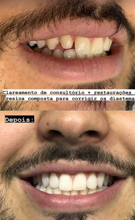 Antes e depois de clareamento e restaurações em resina