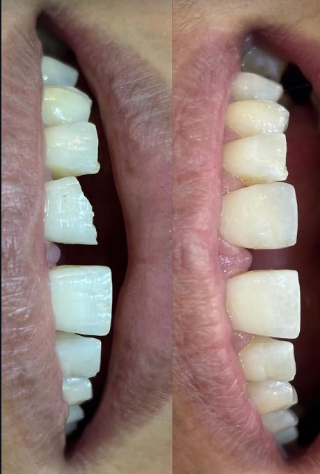 Comparação clínica de restauração estética dental